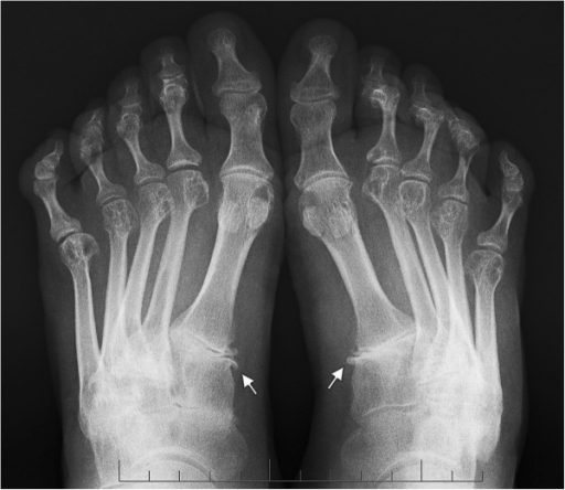 Sign of the metatarsophalangeal instability. Anteropost | Open-i