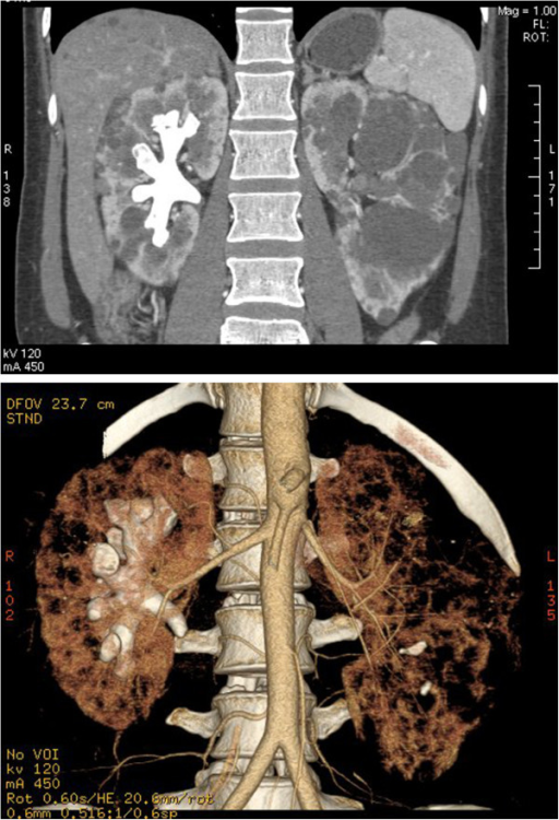 CT images of a complete staghorn calculus in the right | Open-i