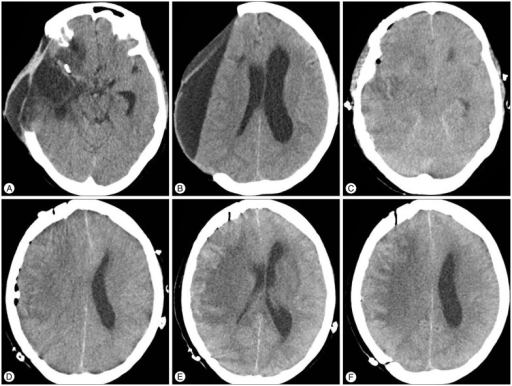 Brain computed tomography scan prior to cranioplasty (A | Open-i
