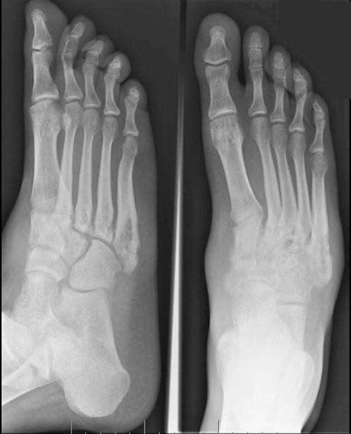 Right foot x-ray on day of admission - 2 views. Abnorma | Open-i