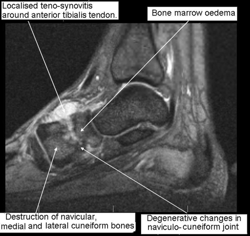 MRI scan right foot, T2 weighted, 5 days after admissio | Open-i