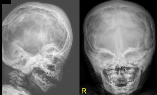 Lateral skull and AP radiographs show marked cranial os | Open-i