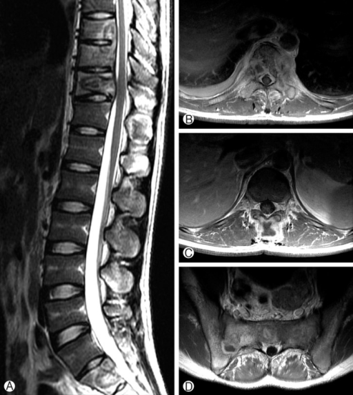 Initial thoracolumbar spine MRI. Sagittal T2-weighted i | Open-i