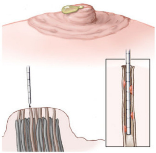 Microdochectomy
