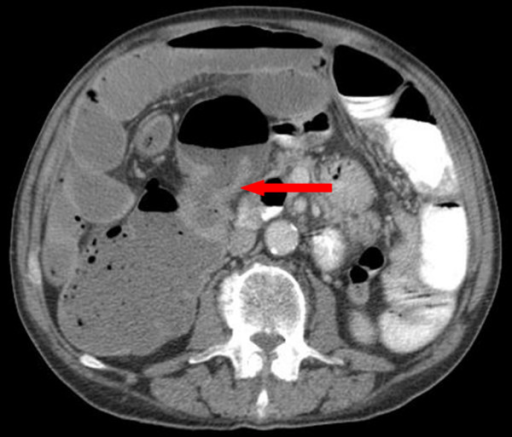 Imaging of the abdomen (cross sectional). CT scan showi | Open-i