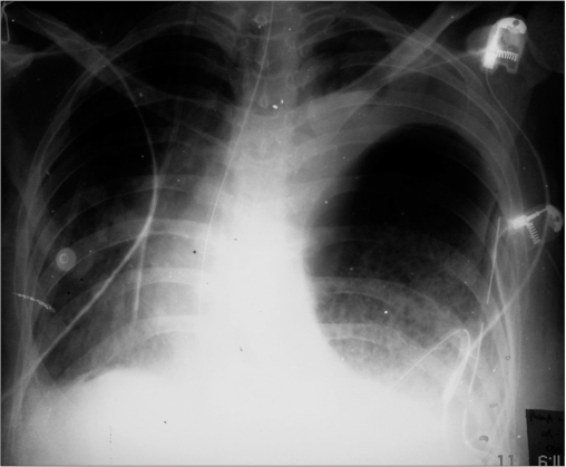 Chest X-ray showing a distended stomach in left hemitho | Open-i