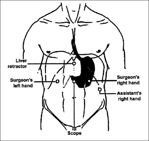 Trocars setup for laparoscopic Heller myotomy and fundo | Open-i