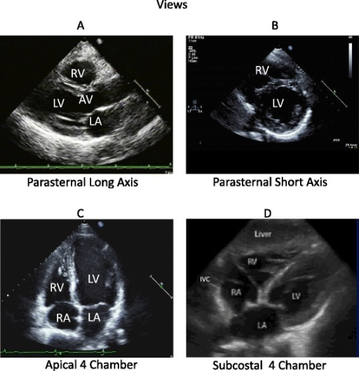 Standard four views of goal-directed echocardiography. | Open-i