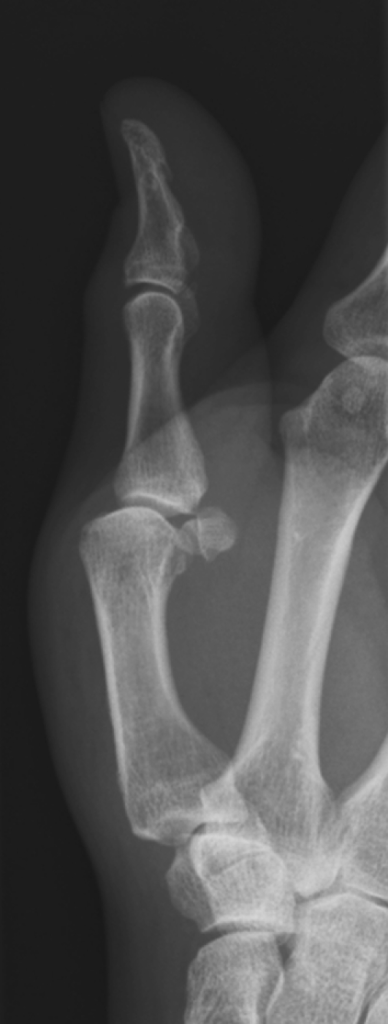 Lateral radiograph of the thumb showing volar subluxati | Open-i