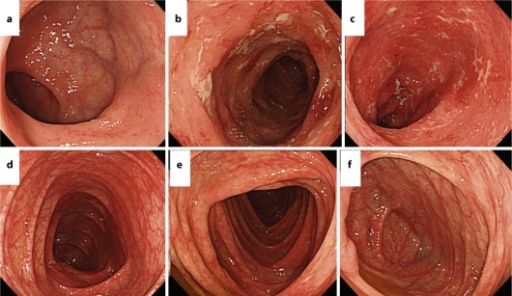 colonoscopy after effects