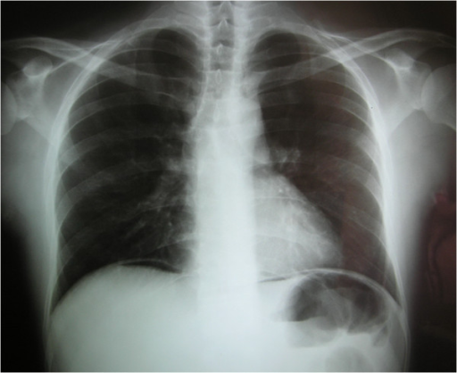 Chest X Ray Revealing Pneumoperitoneum Open I 4393