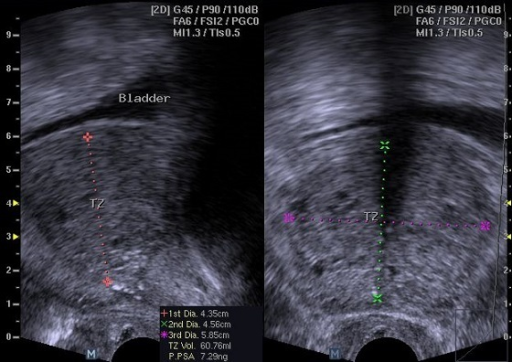 Transrectal Ultrasound Of The Prostate Showing Measurem Open I