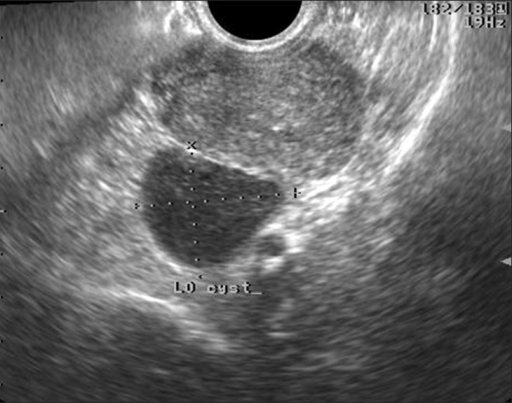 Transvaginal ultrasound showing a left homogeneous cyst | Open-i