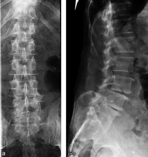 X-rays of AP lumbar spine of a 78-year-old man before s | Open-i