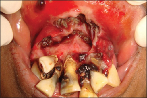 Related Keywords &... Nasal Myiasis