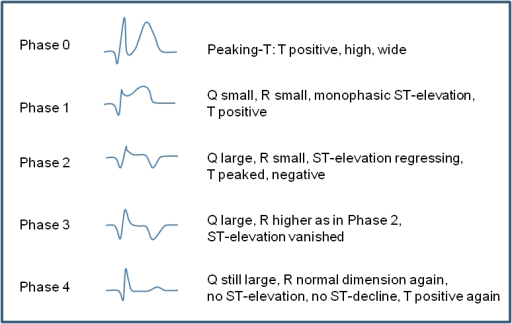 Electrocardiographic phases of STEMI adapted from the P | Open-i