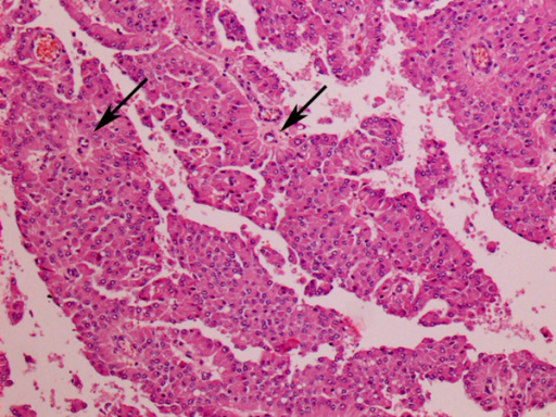 Right testicle, interstitial [Leydig] cell tumor, numer | Open-i