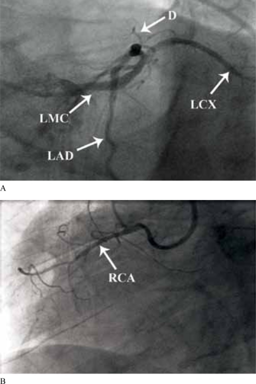 A) Left Coronary Angiogram In Left Anterior Oblique (LA | Open-i