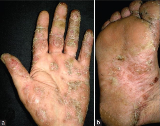 Chronic Plaque Psoriasis Over Left Palm And Right Sole Open I 