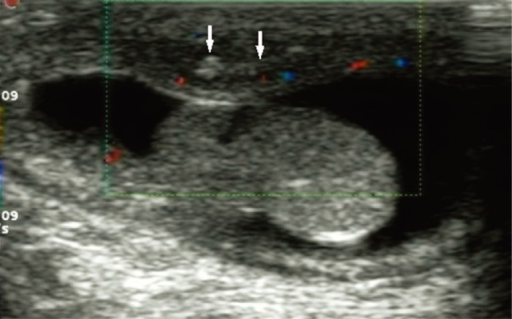 Scrotal Abscess Ultrasound