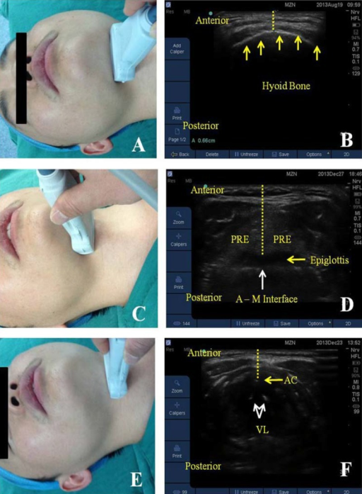 Ultrasound Measurements Of Anterior Neck Soft Tissue Thicknesses Left