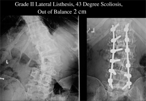 grade i listhesis grade i listhesis