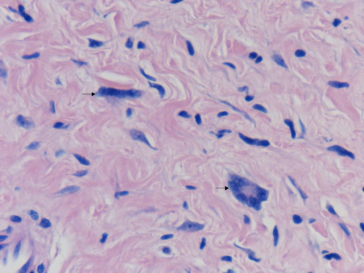 Giant cell fibroblastoma - researchgate.net