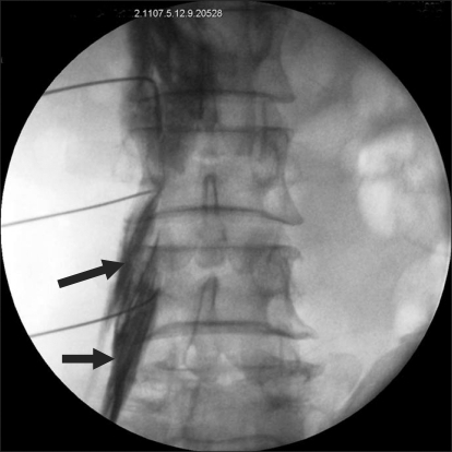 Anteroposterior fluoroscopic view. Psoas muscle injecti | Open-i