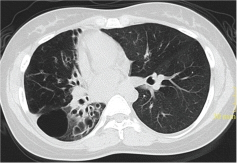 Preoperative chest CT scan revealing right accentuated 