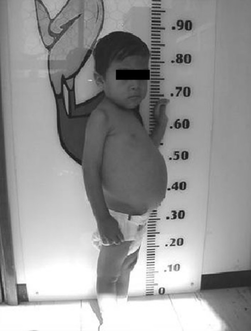 A 2 year and 11months old boy with untreated celiac di