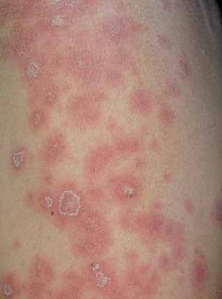 Papulosquamous lesions on the arm of a patient typical | Open-i