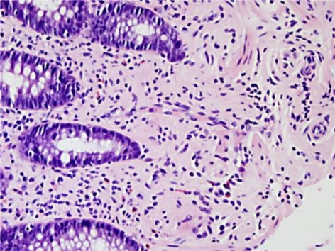 Photomicrograph of a transverse colon polyp. A high-pow | Open-i