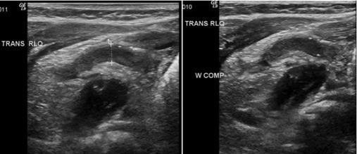 Right lower quadrant ultrasound without (left) and with | Open-i