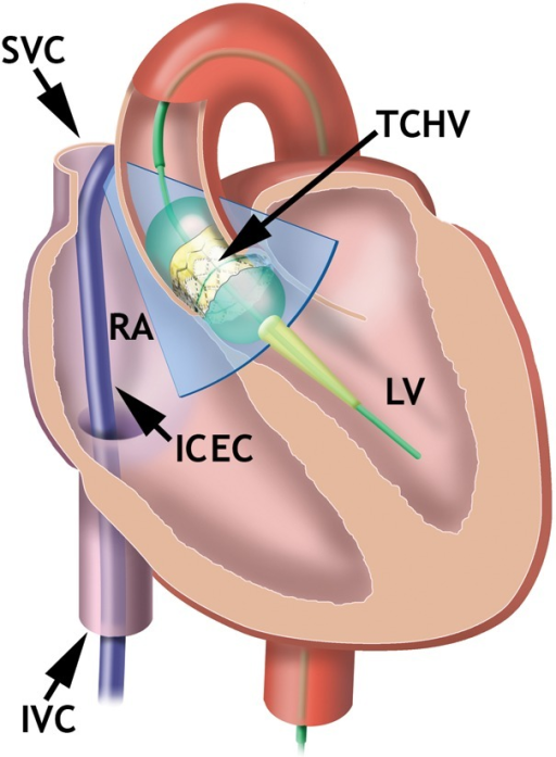 Longitudinal view in transcatheter valve implantation. | Open-i