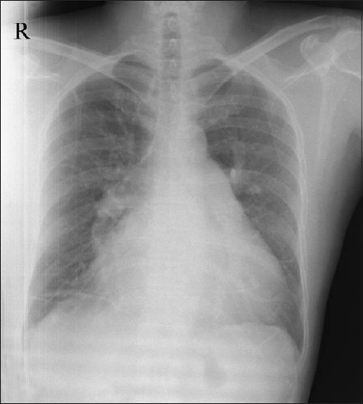 X-ray chest in postero-anterior view showing cardiomega | Open-i