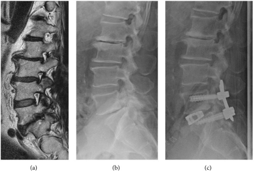 (a) Sagittal T2-weighted MRI showing foraminal stenosis | Open-i