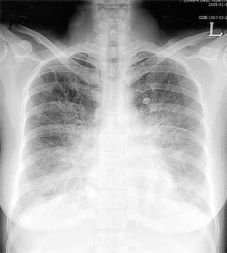 Chest radiograph showing bilateral pulmonary edema. | Open-i