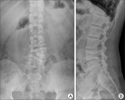 Lumbar radiographs. A : Antero-posterior view showing L | Open-i