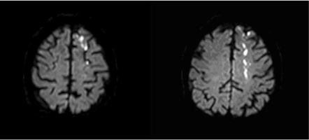 MRI-DWI showing a watershed infarct between left MCA-AC | Open-i