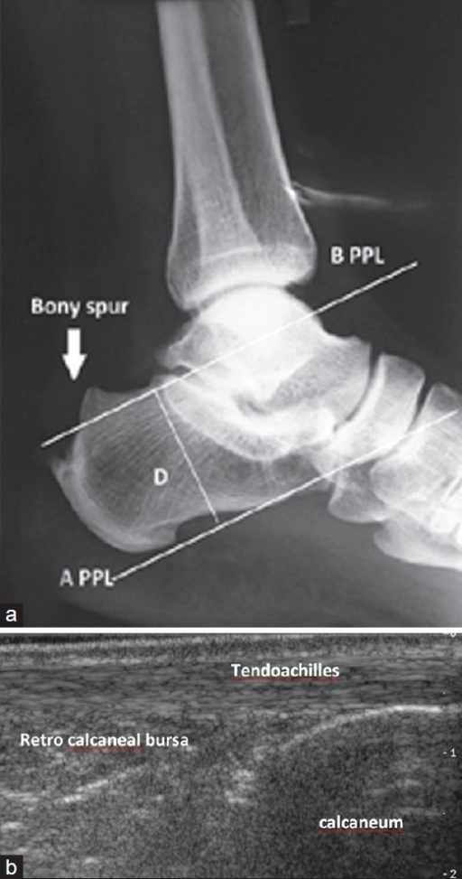 Preoperative X-ray ankle joint lateral view showing (a) | Open-i