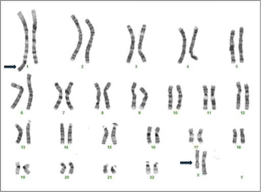 Patient G banded karyotype. Karyotype at 550 band resol | Open-i