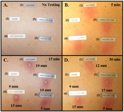 schick test for allergic reaction to tetanus