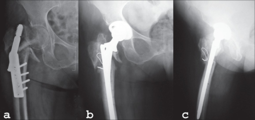 icd 10 cm code for intertrochanteric fracture right hip