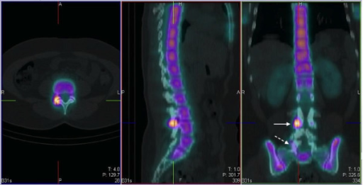 Spectct Images Axial Sagittal Coronal Localizing I Open I