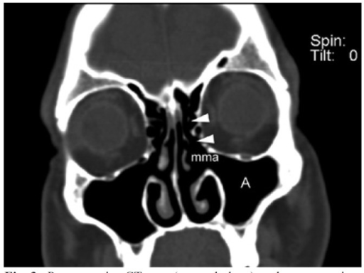 Postoperative CT scan (coronal plane) to the same patie | Open-i