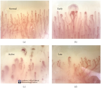 The morphological capillary abnormalities in SSc have been classified in 3 validated patterns (early, active, and late) of microangiopathy by NVC analysis.