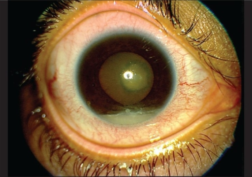 Hypopyon persists in anterior chamber (AC) after topica | Open-i