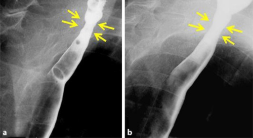 Upper Esophageal Web Seen On Barium-swallow Esophagogra | Open-i