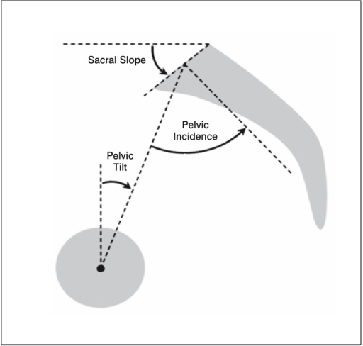 Spinopelvic Parameters Of Sagittal Balance Pelvic Inci Open I