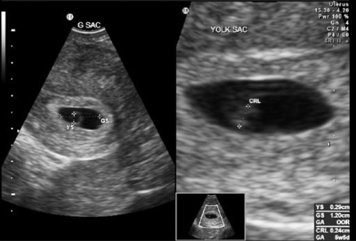 positive transfer embryo after days 7 test pregnancy sac, after embryonic and emb Gestational pole yolk sac,